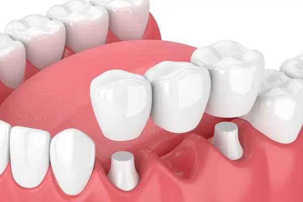 How to Care for Dentures and Bridges