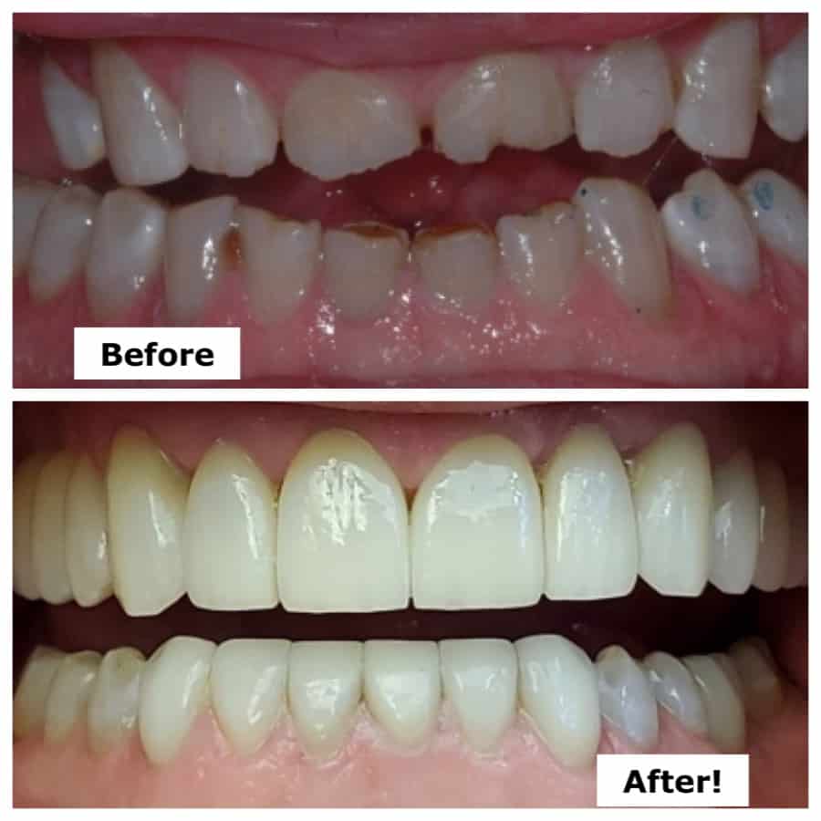 Transforming Smiles: A Wedding Smile Makeover Journey