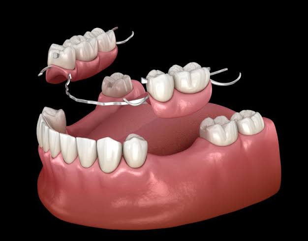 Partial Dentures