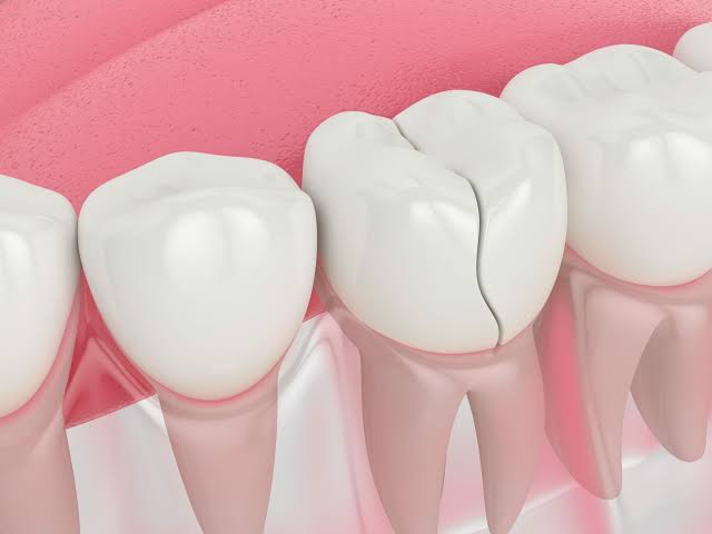 What To Do With a Broken or Chipped Tooth and Its Pain