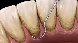 Importance of Periodontal Maintenance