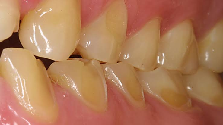 Dental Erosion ; Protecting Teeth from Acidic Attack