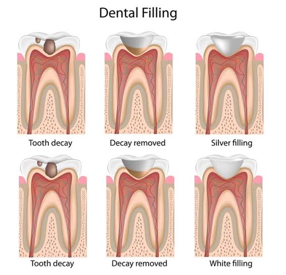 TOOTH FILLING