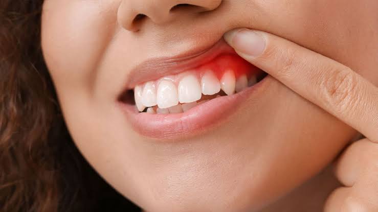 How to avoid gum disease?