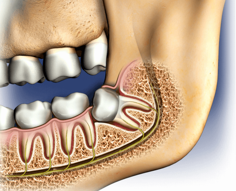 Wisdom Teeth Removal